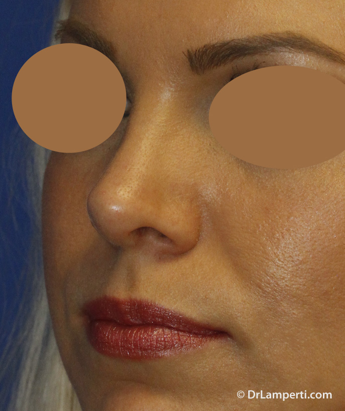 Revision Rhinoplasty After Left Oblique