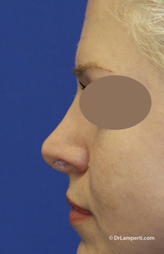 Revision Rhinoplasty Before Left Profile