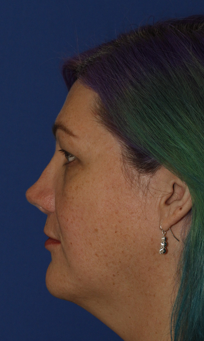 Revision Rhinoplasty Before L Profile