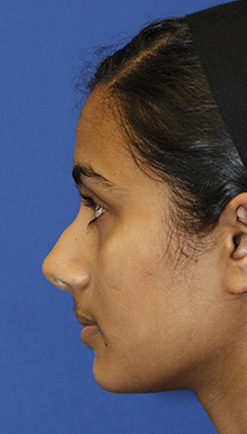 Indian rhinoplasty preop profile