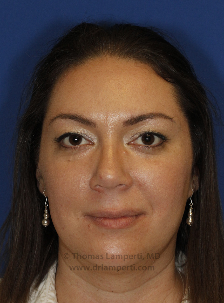 Rhinoplasty After Frontal