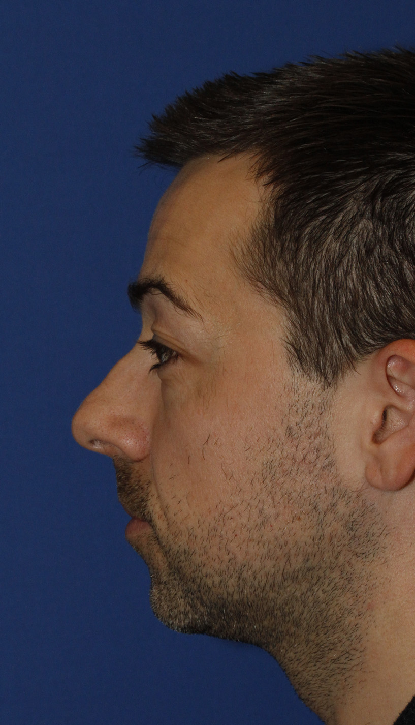 Before Rhinoplasty L Profile