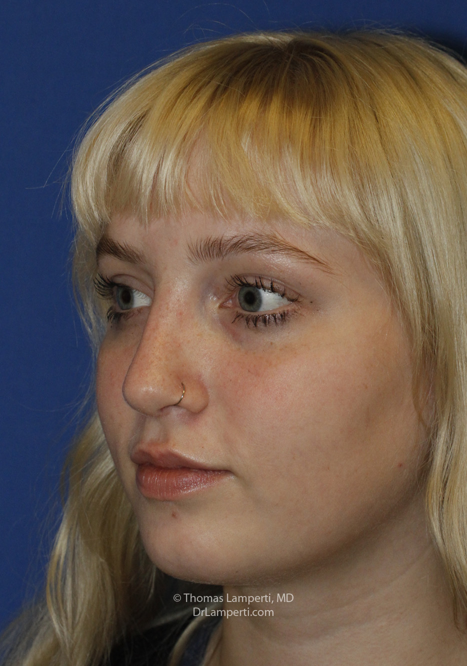Rhinoplasty After L Oblique