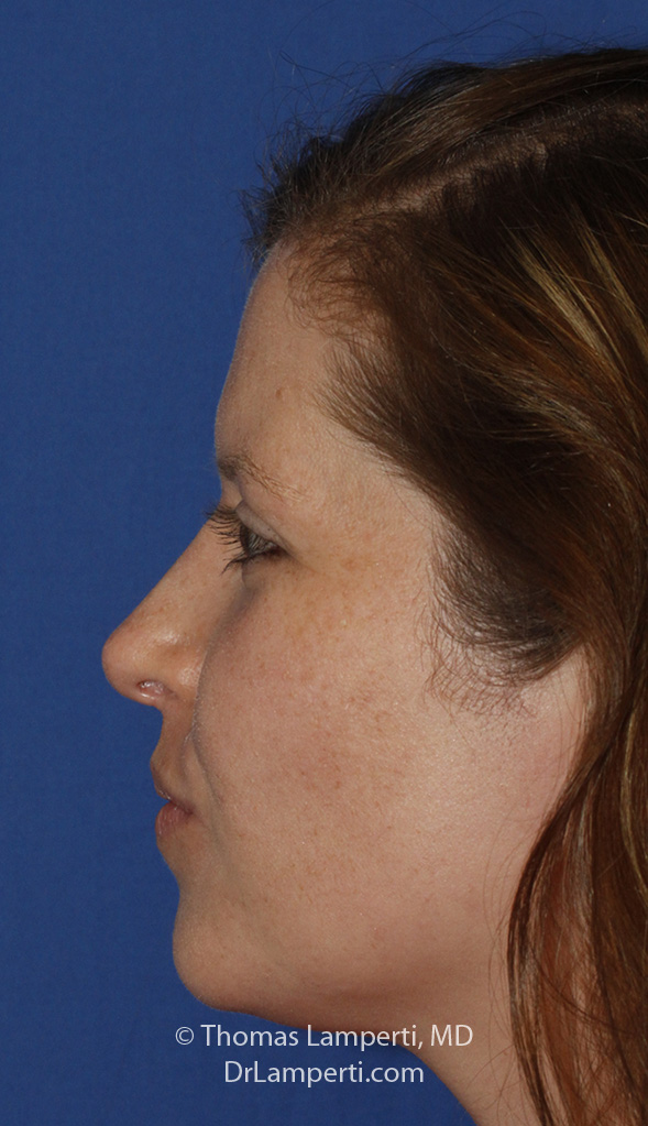 Rhinoplasty L Profile After