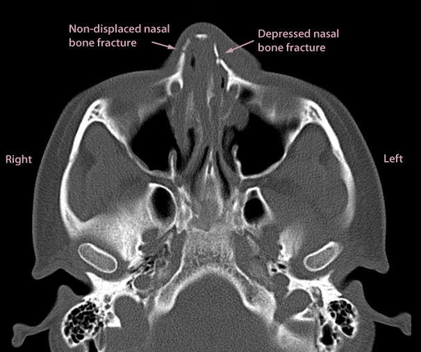 Axial Ct Scan Multiple Fractures Of Nasal Bones Maxil Open I My XXX