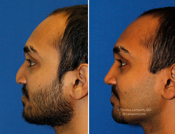 patient-57-cleft-rhinoplasty-l-profile-montage.jpg