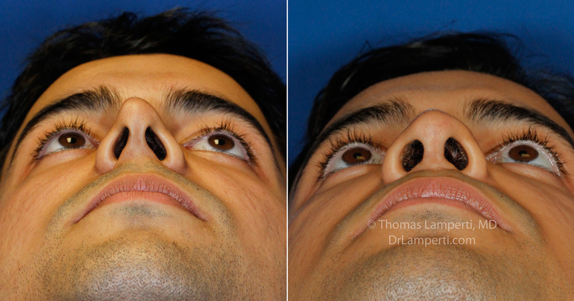 Revision rhinoplasty patient 15 pinched tip repair before and after photos