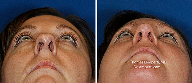 Rhinoplasty patient 67 before and after base view asymmetric nostril repair
