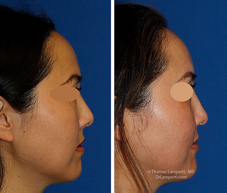 Rhinoplasty patient 69 tip derotation before and after montage