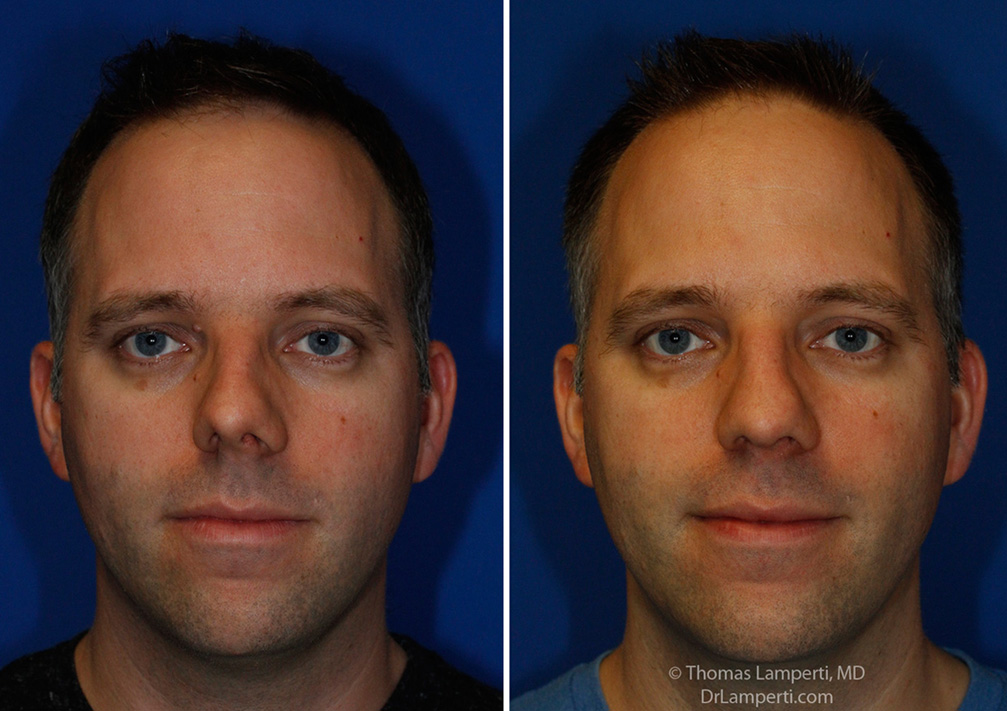 Rhinoplasty patient 55 crooked nose repair frontal