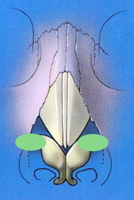 Schematic showing were bilateral alar batten grafts are placed
