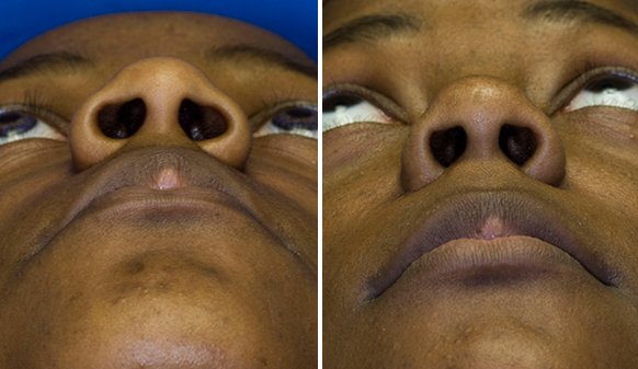 African American nostril reduction base view