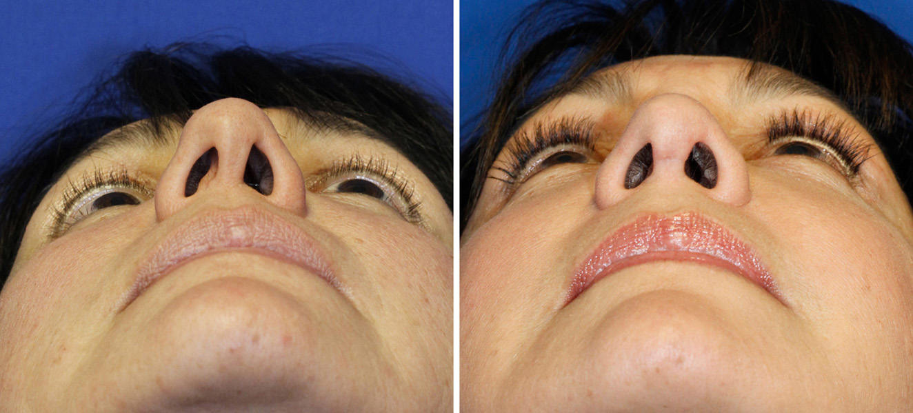 Asymmetric nostril before and after septal reconstruction
