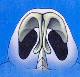 Schematic of a boxy or trapezoidal nasal base