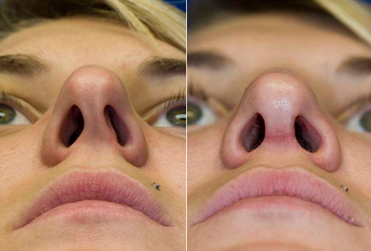 Caudal septal deviation before and after caudal septal reconstruction