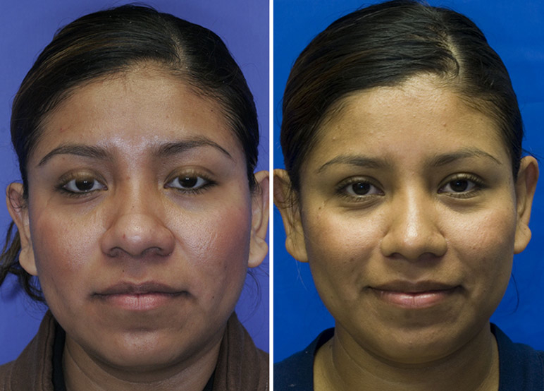 Hispanic bulbous tip rhinoplasty frontal view