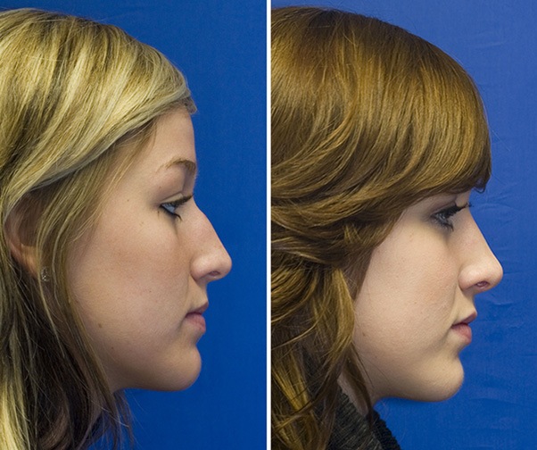 Patient 4 bony hump reduction profile