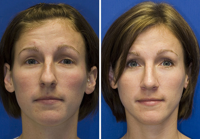 Patient 2 bulbous tip rhinoplasty with LLC overlay