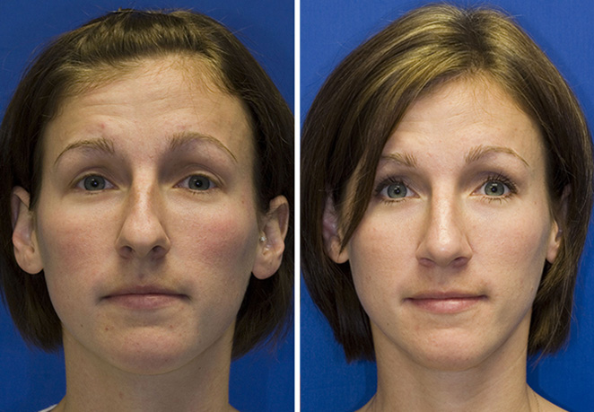 Seattle Face & Skin - Facial plastic surgery and rejuvenation - Seattle  Face and Skin