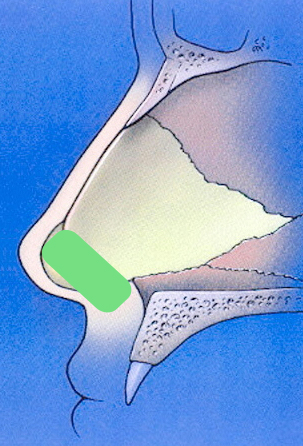 Caudal septal extension graft schematic