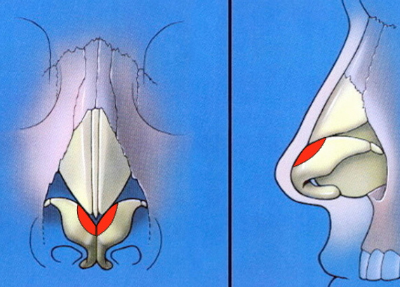 Cephalic trim of lower lateral cartilages schematic