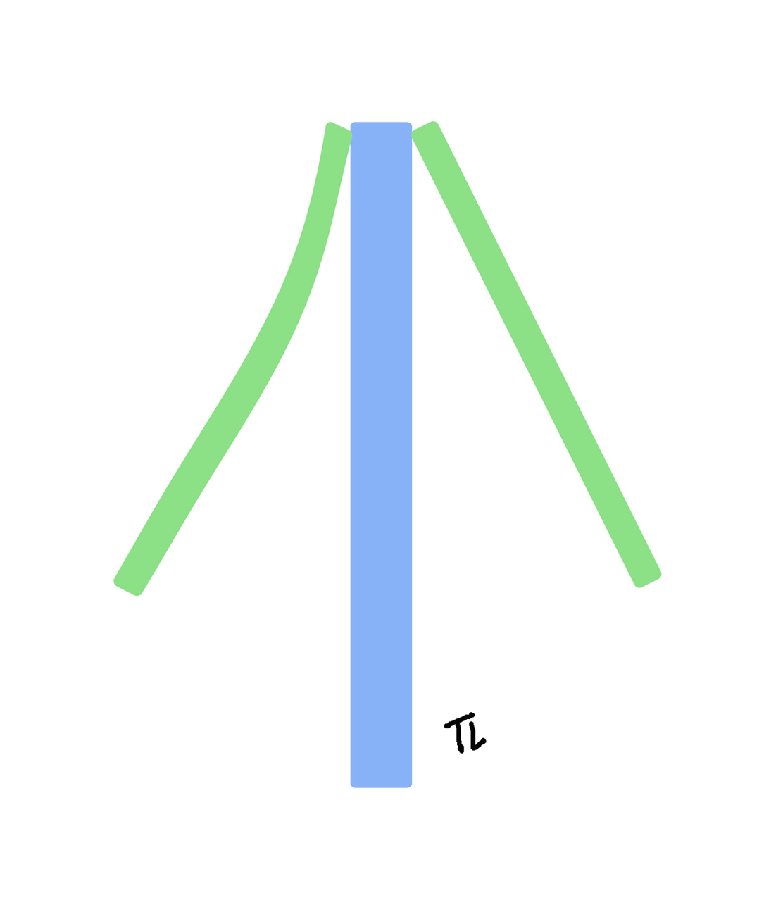 Collapsed right upper lateral cartilage schematic