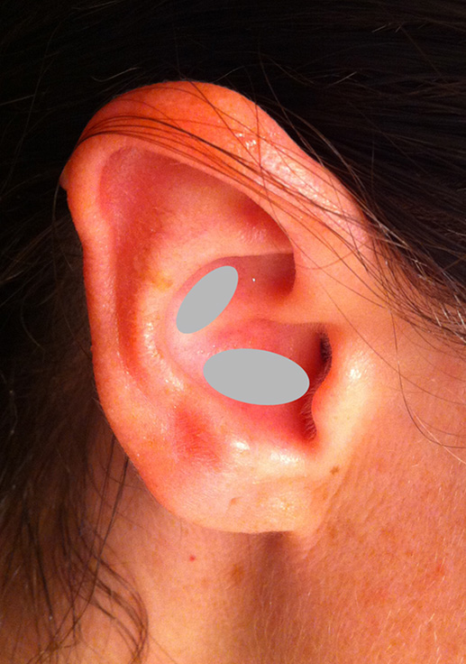Conchal cartilage ear cartilage harvest locations