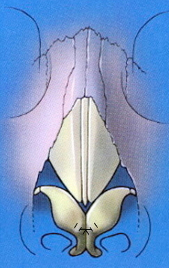 Dome binding tip suture frontal view showing sutures placed at the tip defining points