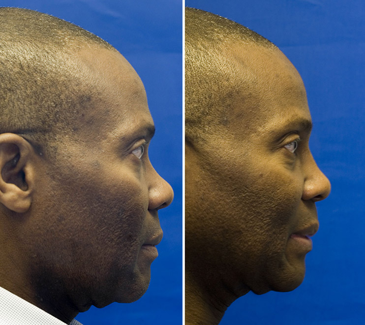 African American bridge augmentation with septal cartilage