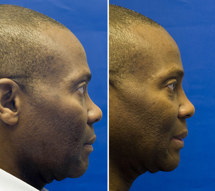 African American dorsal nasal augmentation with cartilage grafting