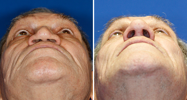Collapsed nasal tip repaired with rib cartilage graft to rebuild a missing cuadal septum