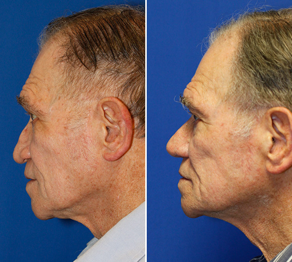 droopy-ptotic-tip-rhinoplasty-in-seattle-rhinoplasty-surgeon