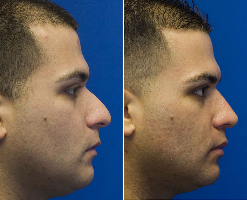 Ethnic Rhinoplasty Clinic in Los Angeles - Rawnsley Plastic Surgery