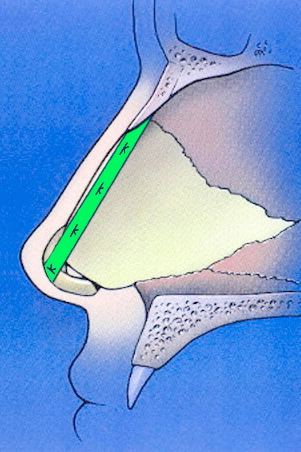 Extended spreader graft schematic profile