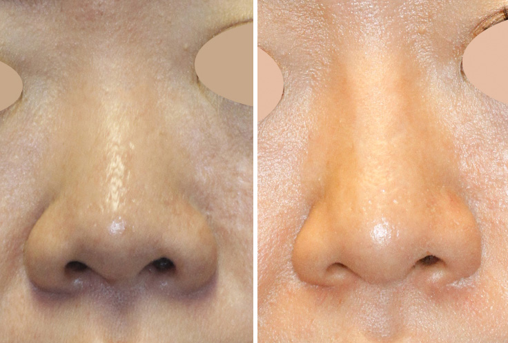 Asian rhinoplasty frontal photo (click to see more photos of this patient)