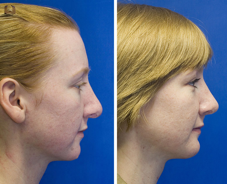 Revision rhinoplasty pollybeak deformity and hanging columella repair combined with chin implantation 