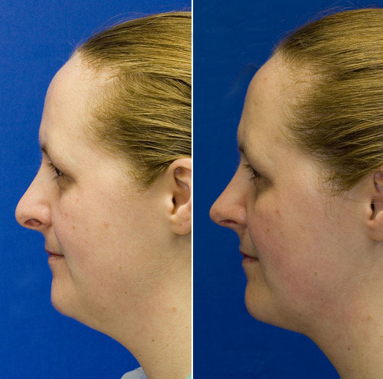 Pollybeak deformity and hanging columella repair combined with neck liposuction