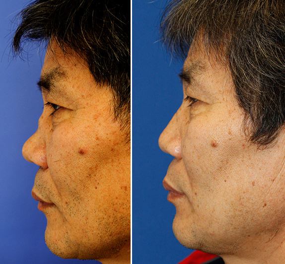 Before and after Wegerner's saddle nose deformity rhinoplasty repair