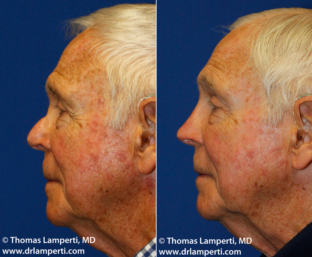 upturned nose caused by silicon implant - Revised rib carilage rhinoplasty  > Before & After Photo