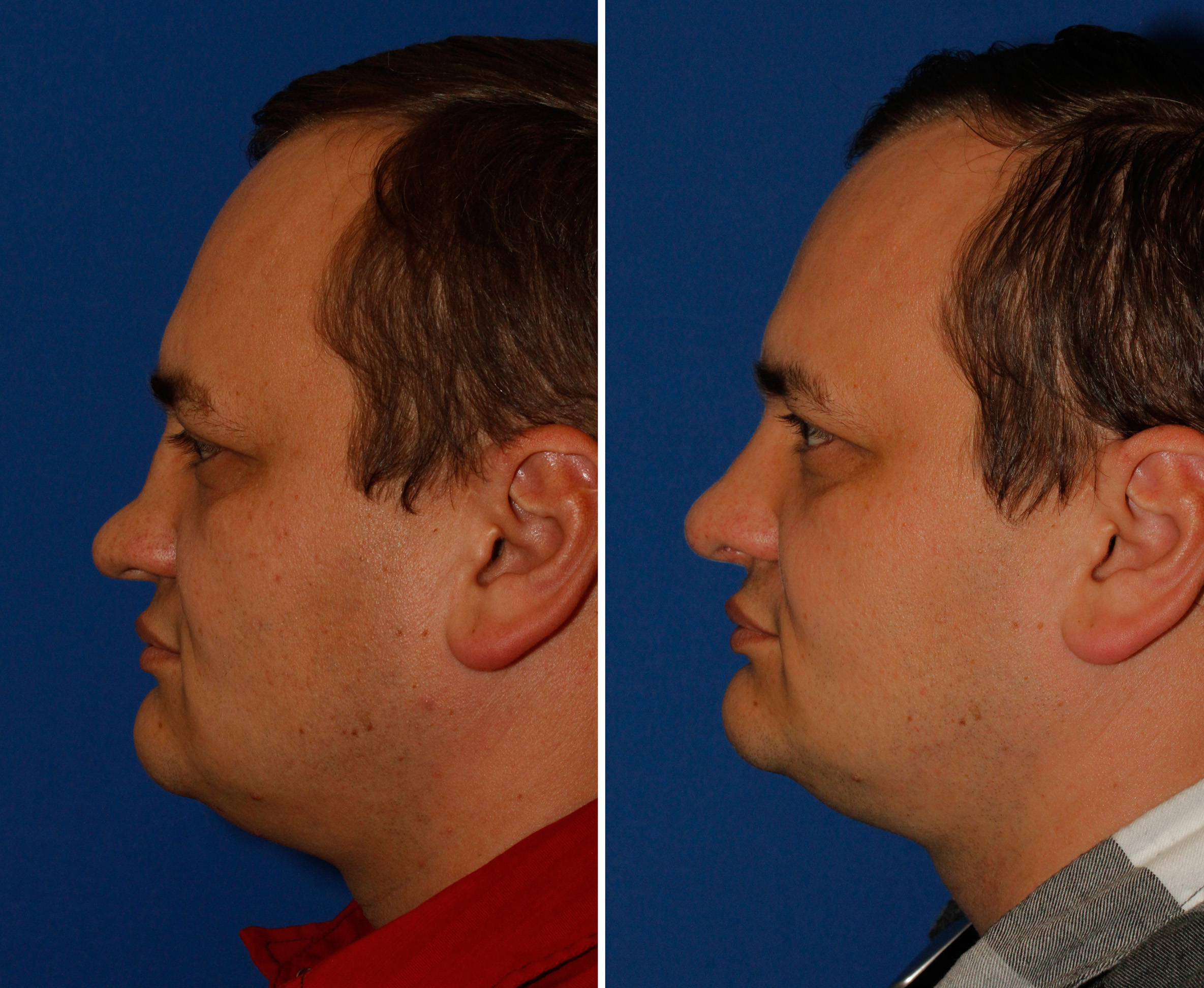 Saddle nose rhinoplasty patient 50 profile before and after photos
