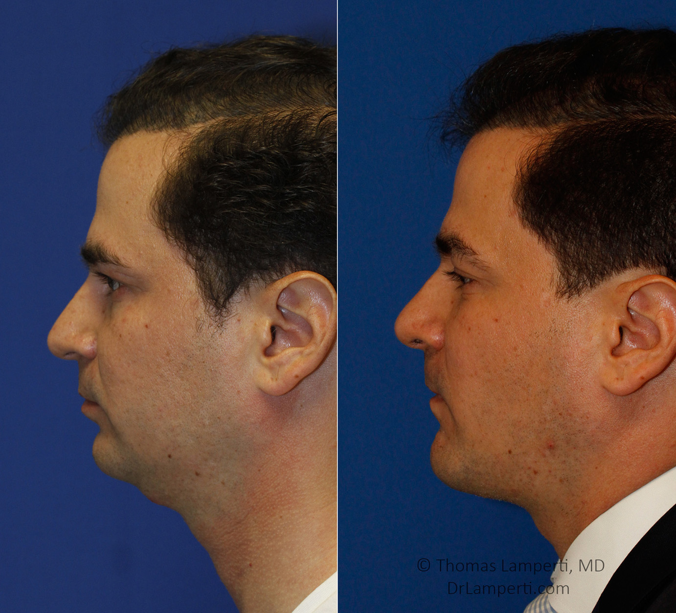 Rhinoplasty patient 51 before and after droopy tip repair rhinoplasty