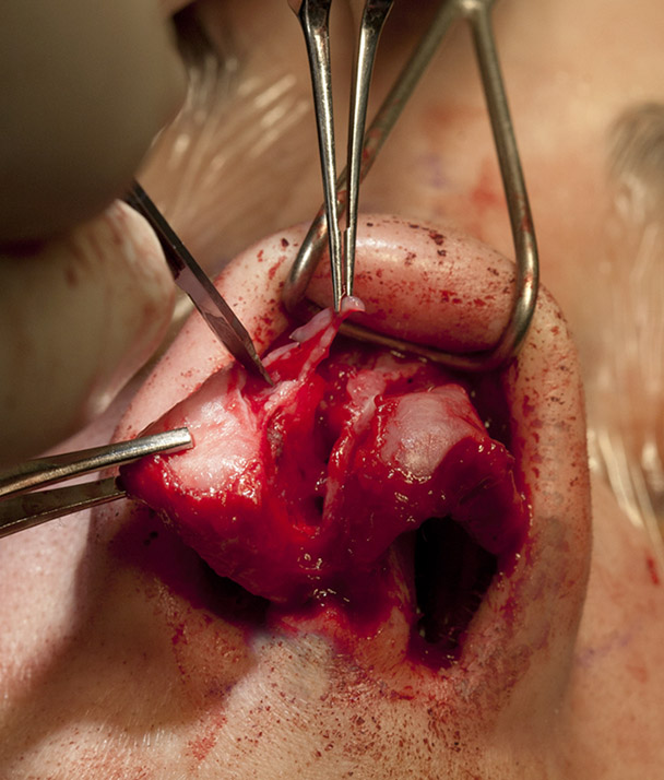 LLC strut graft placement showing initial cephalic trim to gain access to the area under the cartilage