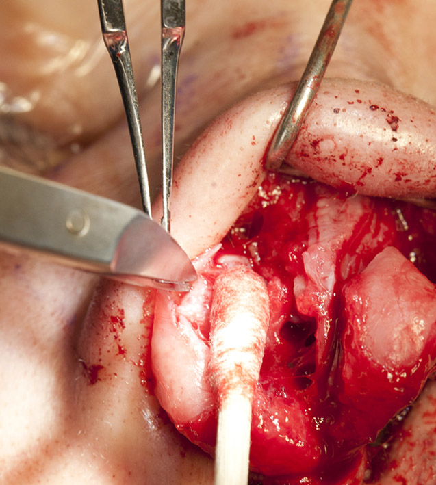 LLC strut graft dissection graft pocket