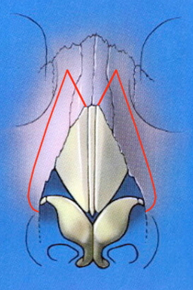 Medial and lateral osteotomy schematic