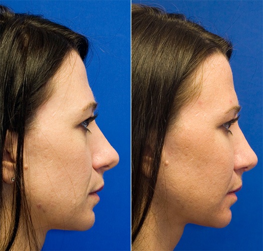 Long tip combined with cheek fat grafting rhinoplasty