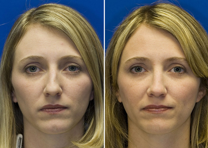 crooked nose before and after