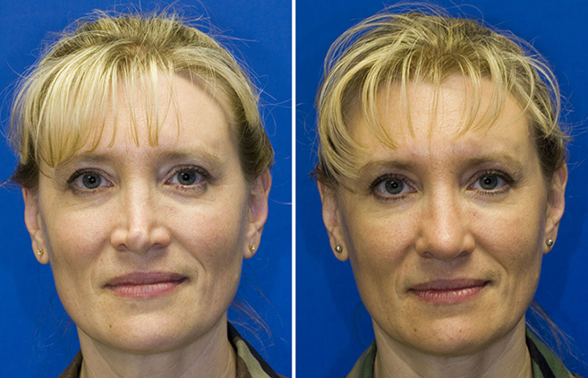 Revision rhinoplasty patient 1 frontal