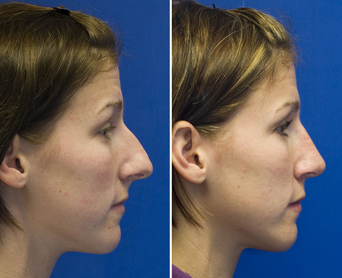 Over projected long nose rhinoplasty profile