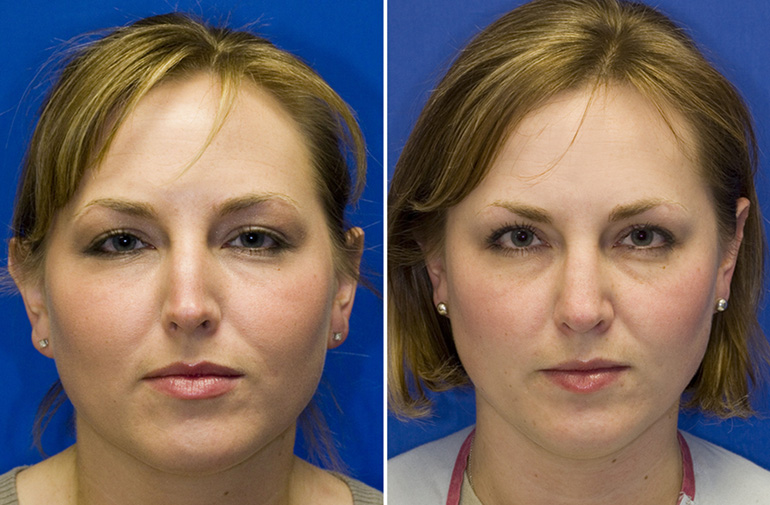 Patient 24 narrow nose repair frontal view