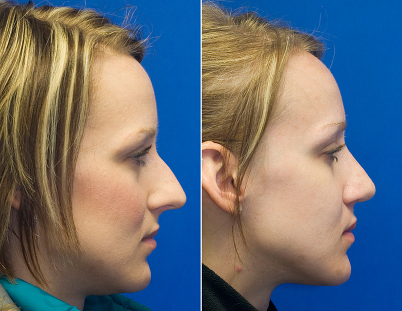 Patient 25 long nose profile